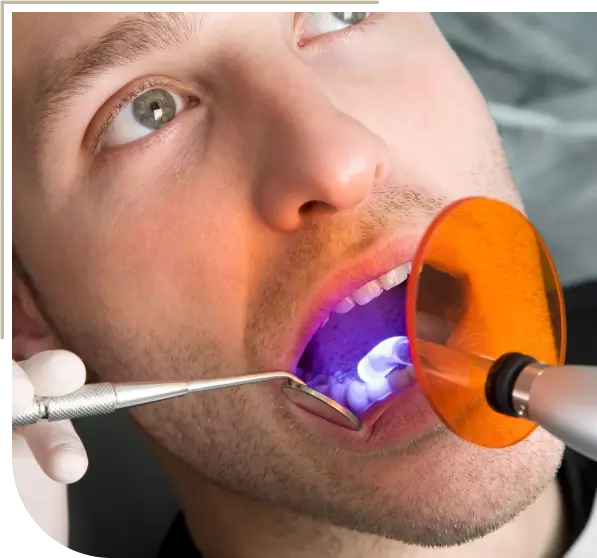 Preserving Oral health with Fillings in melbourne