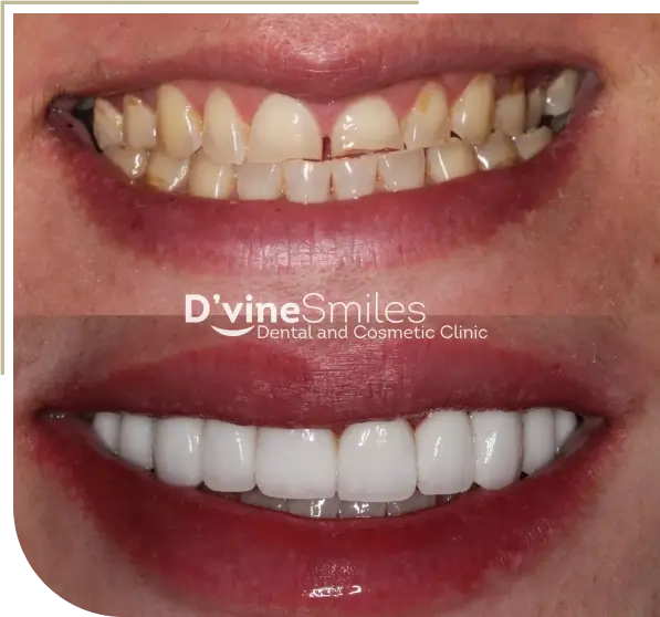 Reliable Crowns in Melbourne