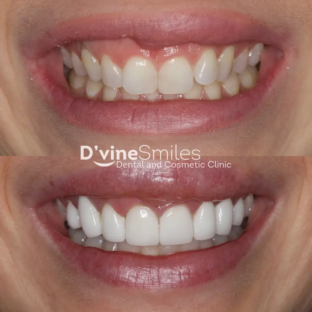 Dental Veneers case 1 Dvine Smiles