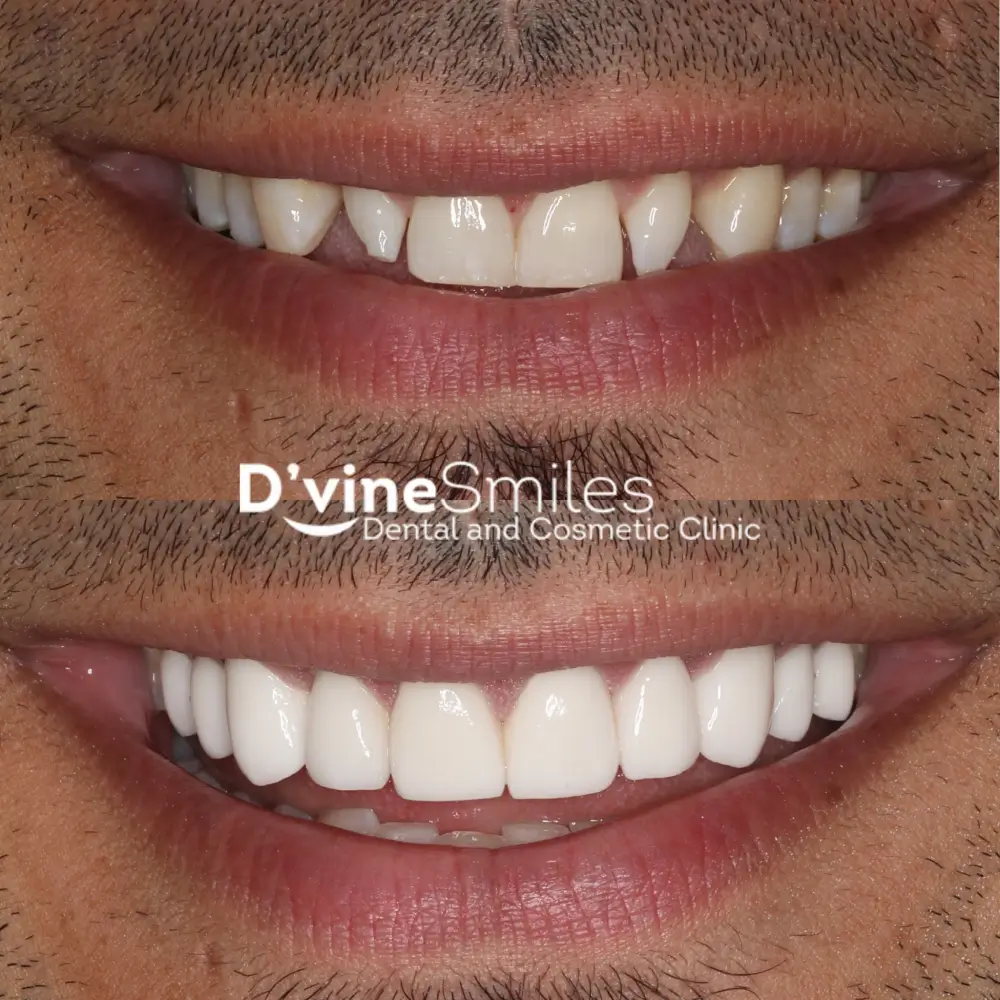 Dental Veneers case 2 Dvine Smiles