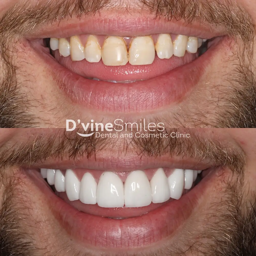 Dental Veneers case 3 Dvine Smiles