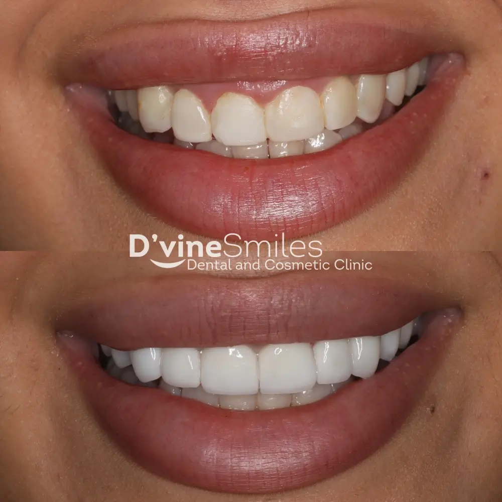Dental Veneers case 4 Dvine Smiles