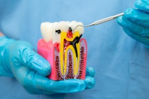 Does Vaping Cause Tooth Decay cavities