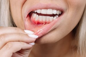 Does Vaping Cause Tooth Decay problem